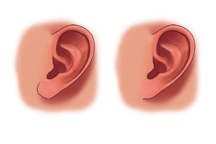 and whether you have attached or free earlobes